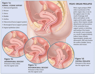 What is a pelvic mesh?